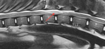 תמונת sagittal T2 של בדיקת ה MRI - חוט השדרה ובתוכו הלקות